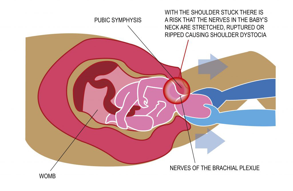 erb's palsy graphic displaying information about the condition