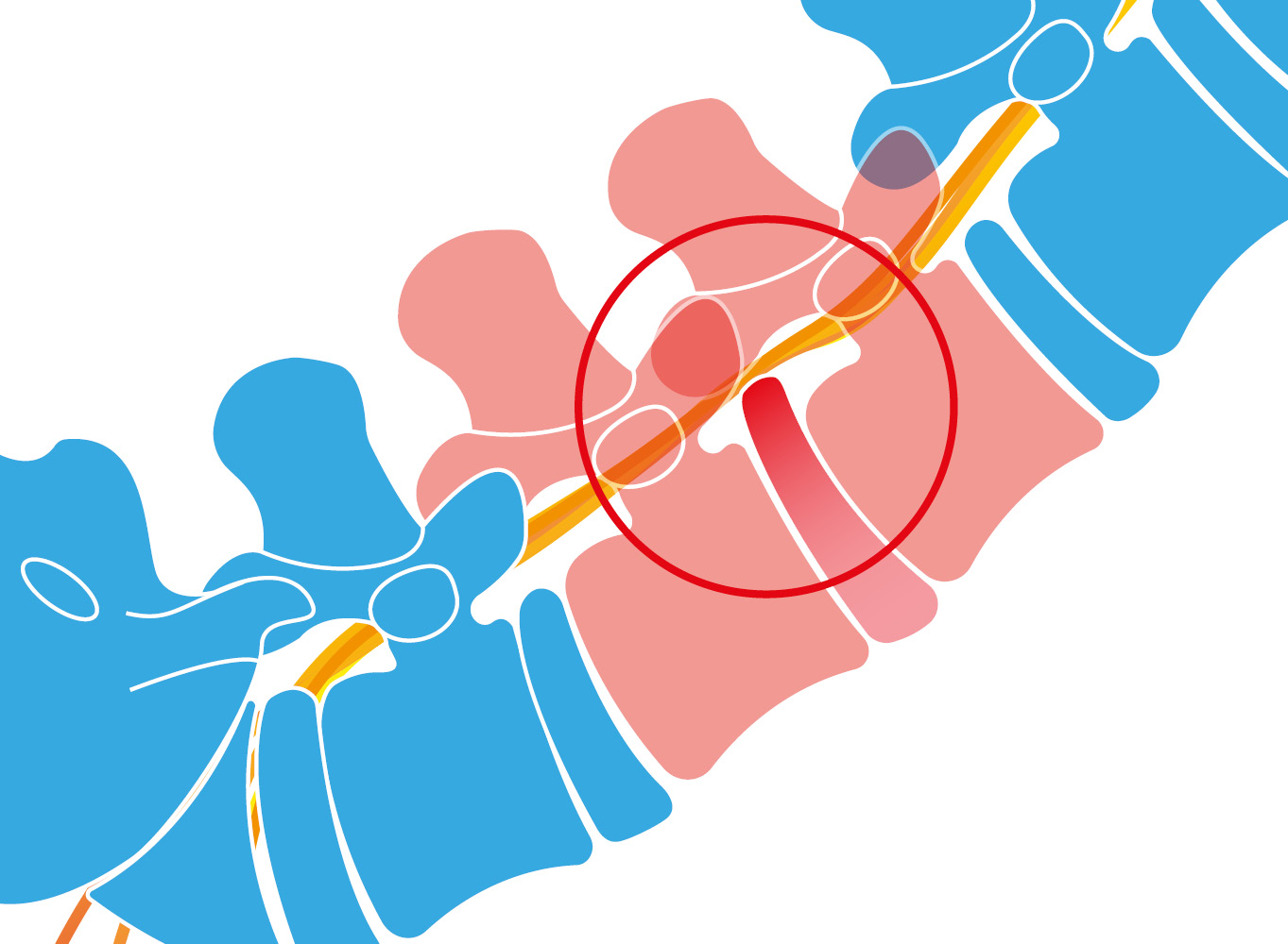 Diagram of spinal column and pressure on nerves