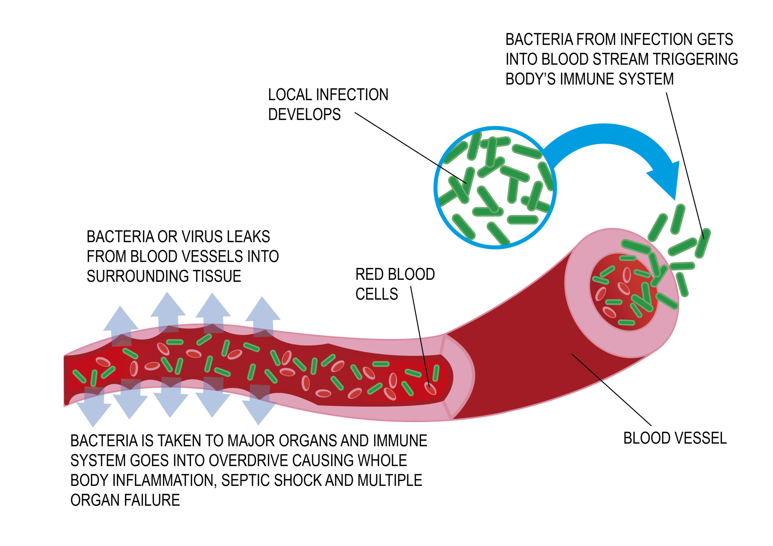 A annotated diagram of a blood vessel and how sepsis spreads through the body